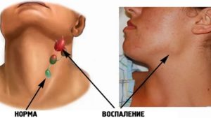 Воспаление подчелюстного лимфоузла: признаки и лечение