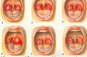 Признаки фолликулярной ангины у детей и методика лечения недуга