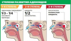 Консервативное лечение аденоидов у детей: симптомы болезни и основные принципы лечения