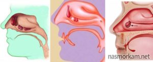 Полипоз носа: основные симптомы недуга
