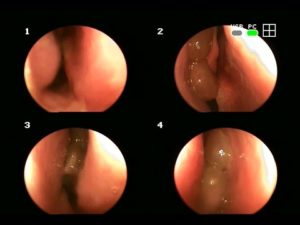 Полипоз носа: основные симптомы недуга
