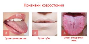 Сильно сохнет во рту ночью? Ксеростомия: причины и лечение