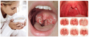 Слизь на задней стенке горла: основные причины симптома