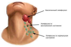 Увеличенные лимфоузлы на шее: эффективное лечение недуга