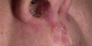 Причины возникновения стафилококка в носу и эффективные методы лечения инфекции