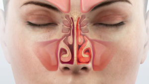 О чем свидетельствует постоянная заложенность носа без насморка?