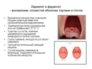 Основные симптомы ларингита и фарингита