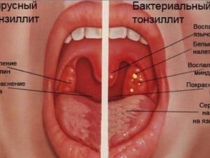 Воспалилась миндалина с одной стороны: причины и лечение