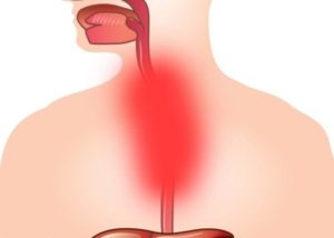 Чем опасна изжога в горле и как ее лечить?
