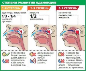 Консервативное лечение аденоидов у детей: симптомы болезни и основные принципы лечения