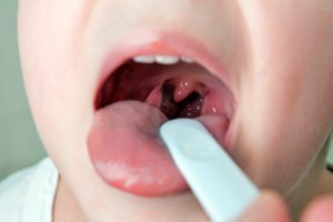Ожог слизистой горла: медикаментозное и народное лечение