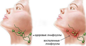 Воспаленные лимфоузлы под челюстью: эффективное лечение