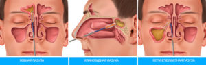 Воспаление носовых пазух: медикаментозное и хирургическое лечение