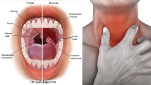 Чешется горло изнутри: причины, опасные признаки и методы лечения