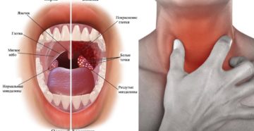 Чешется горло изнутри: причины, опасные признаки и методы лечения
