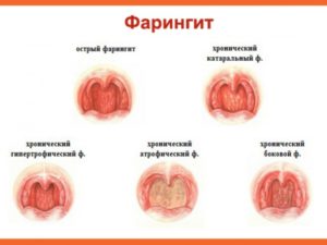 Острый фарингит у детей: особенности развития и различные способы лечения