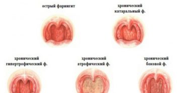 Острый фарингит у детей: особенности развития и различные способы лечения