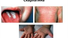 Скарлатина: основные симптомы и период заразности