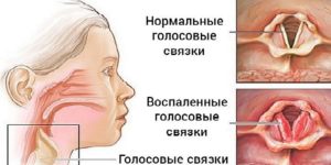 Почему пропал голос и чем лечить афонию?