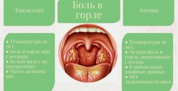 Что делать, если болит горло при беременности: причины, симптоматика и лечение