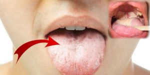 Грибок полости рта: основные признаки и способы лечения кандидоза