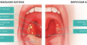 Чем лечить ангину у взрослого и когда нужны антибиотики?