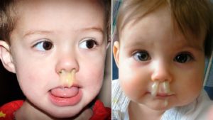 Что делать, если у ребенка заложен нос, а соплей нет