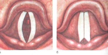 Почему возникает паралич гортани, чем он опасен и как лечиться?