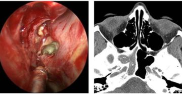 Компьютерная томография пазух носа: процедура и возможные результаты