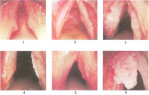 Воспаление голосовых связок стадии, формы и лечение ларингита