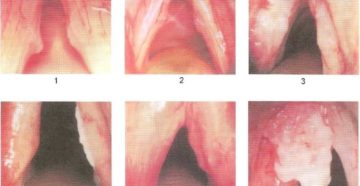 Воспаление голосовых связок стадии, формы и лечение ларингита