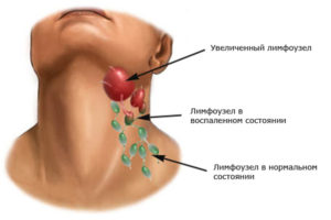 Воспаленные лимфоузлы под челюстью: эффективное лечение