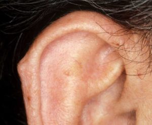 О чем свидетельствует шишка на ушной раковине?