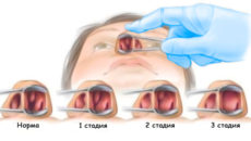 Полипы в носу: причины появления, стадии и лечение
