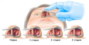 Полипы в носу: причины появления, стадии и лечение