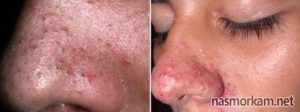 Причины возникновения стафилококка в носу и эффективные методы лечения инфекции