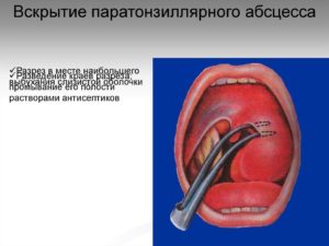 Причины развития паратонзиллярного абсцесса и методы лечения