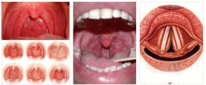 Невроз глотки: основные симптомы недуга