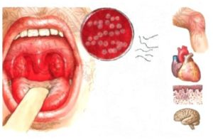 Стрептококк в горле: основные симптомы и способы лечения инфекции