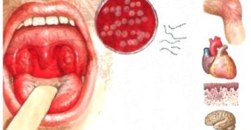 Стрептококк в горле: основные симптомы и способы лечения инфекции