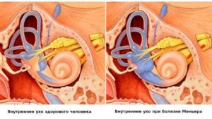 Жидкость во внутреннем ухе синдром Меньера: симптомы и лечение