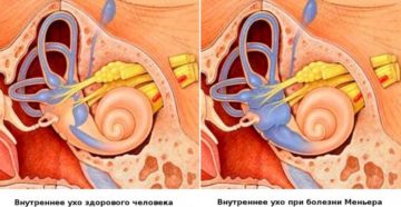 Жидкость во внутреннем ухе синдром Меньера: симптомы и лечение