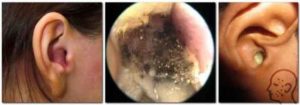 Ушной грибок у человека: основные симптомы и эффективные методы лечения отомикоза