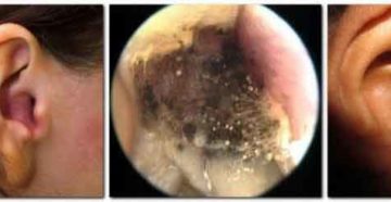 Ушной грибок у человека: основные симптомы и эффективные методы лечения отомикоза
