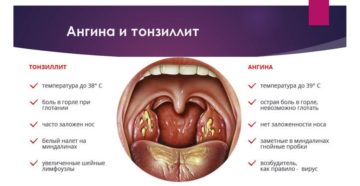 Основные причины боли в горле и чем их лечить