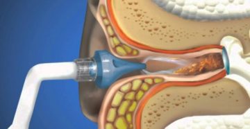 Как правильно пробить и удалить ушную пробку в домашних условиях?