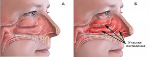 Особенности развития ринита и как быстро вылечить слизистую носа