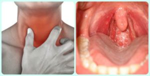 Герпес в горле: основные симптомы вирусной инфекции