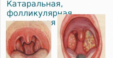 Причины возникновения рыхлых миндалин у ребенка и способы лечения