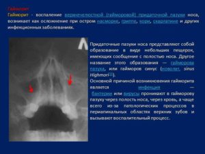 Гайморовы пазухи эффективное лечение воспаления